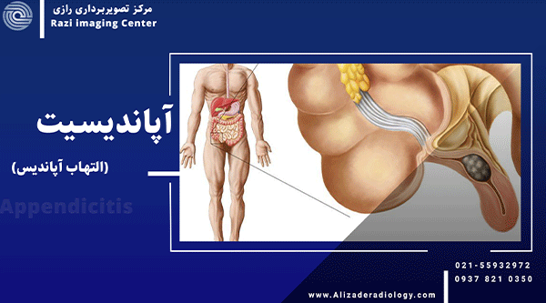 آپاندیسیت(التهاب آپاندیس)