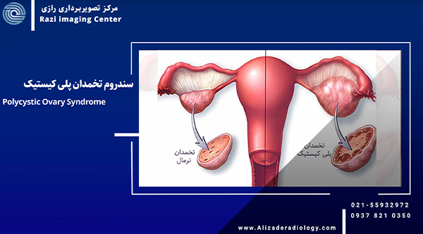 سندروم تخمدان پلی کیستیک  (Polycystic Ovary Syndrome)