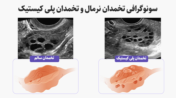 تشخیص سندروم تخمدان پلی کیستیک با سونوگرافی 