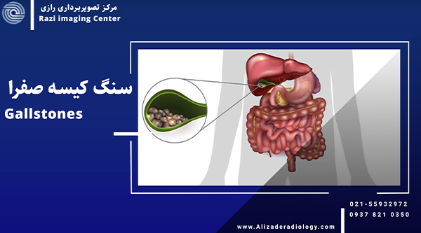 سنگ کیسه صفرا چیست؟ | علائم، تشخیص و درمان آن