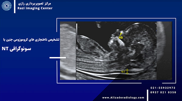 سونوگرافیNT چیست | هفته چندم انجام می شود؟ | NT و تعیین جنسیت