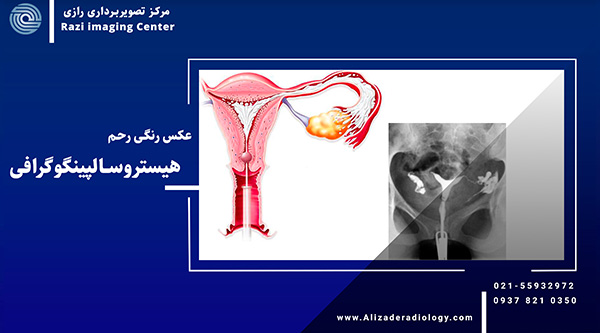 عکس رنگی رحم | هسیتروسالپینگوگرافی