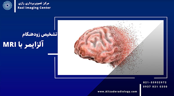 تشخیص زود هنگام بیماری آلزایمر با MRI