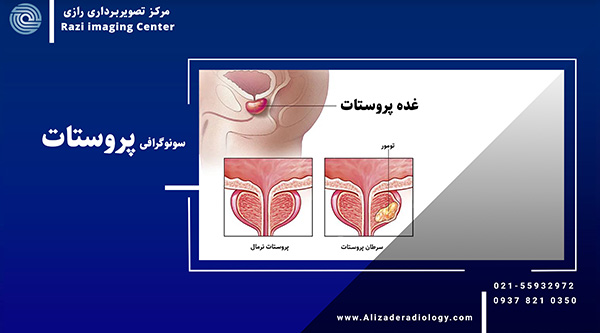 پروستات چیست؟ | التهاب و سرطان پروستات | سونوگرافی پروستات