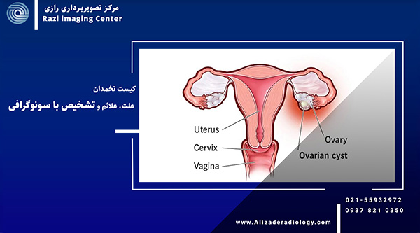 تشخیص کیست تخمدان با سونوگرافی | علت، علائم آن
