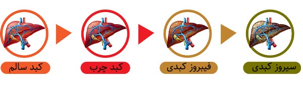 انواع کبد چرب