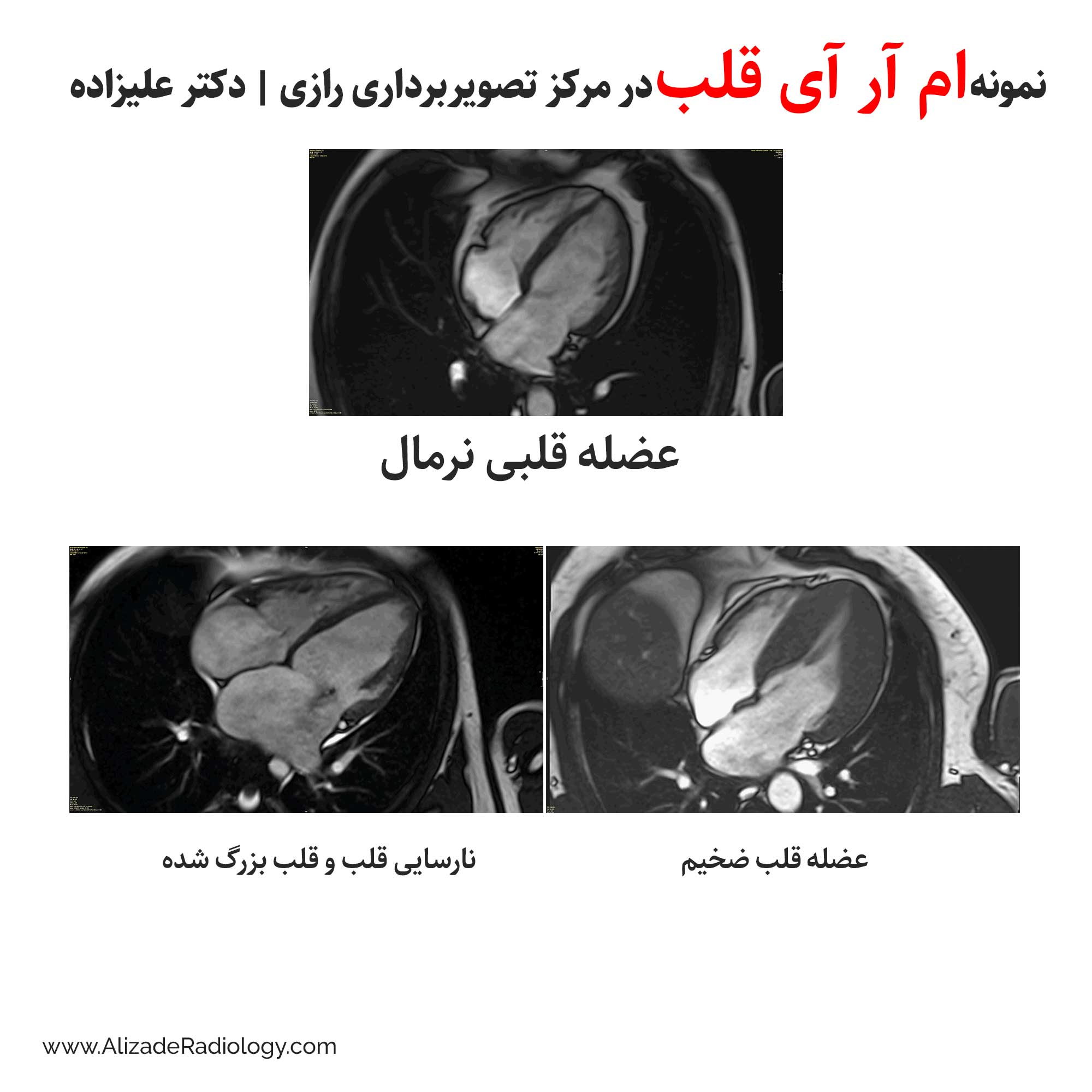 تفسیر نتایج ام آر آی قلب 