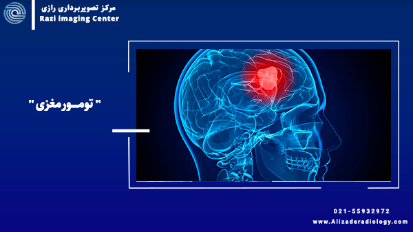 چرا تومور مغزی به وجود می آید؟